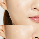 COSRX Acne Pimple Master Patch (24 Patches) - Kiyoko Beauty